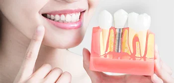 dental implants 3