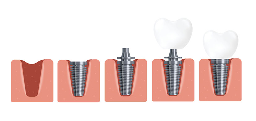 stages of implant