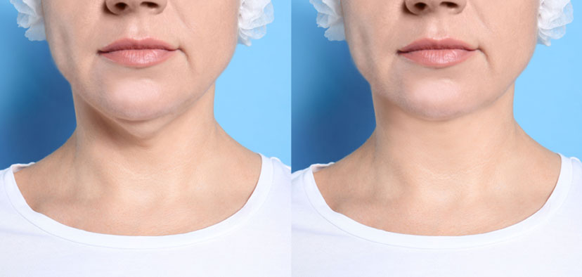 Ultherapy vs other methods