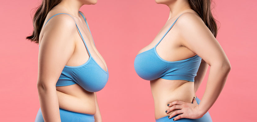 what is breast lift