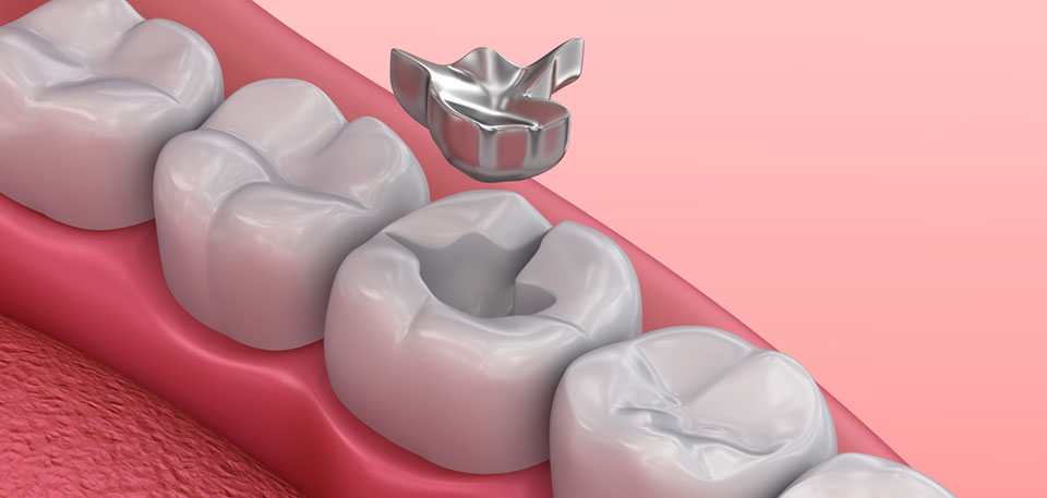 how dental restoration is done