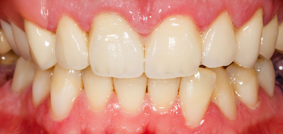 dental restoration after