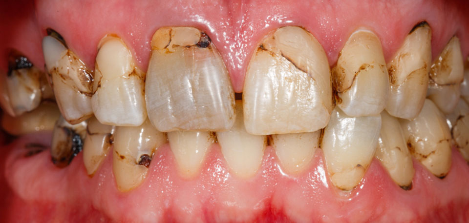 dental restoration before