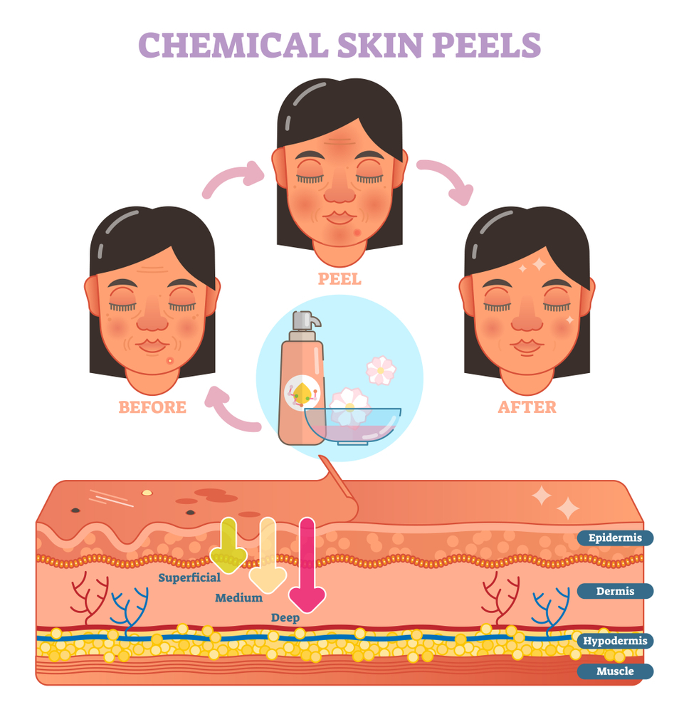 stages of chemical peeling