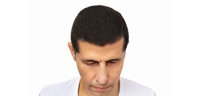 hair transplant In Iran after
