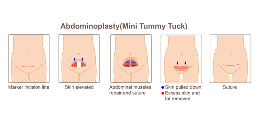 What is Tummy Tuck?