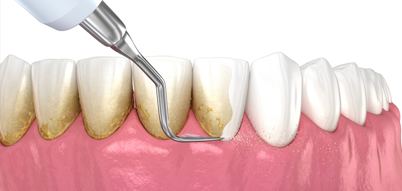 what is dental scaling