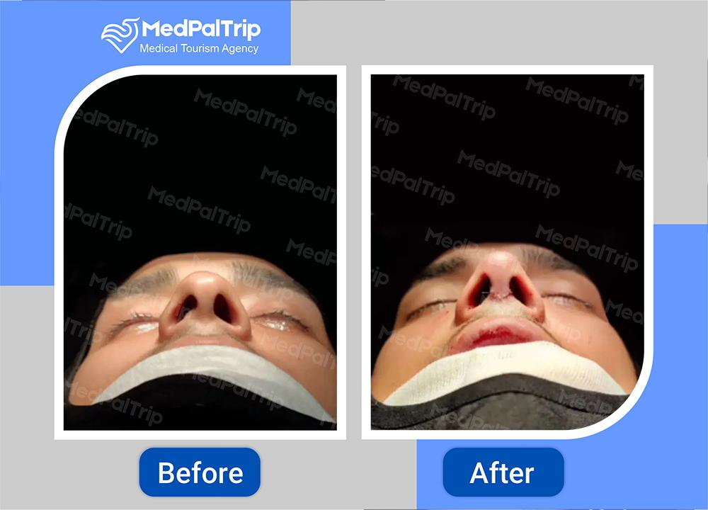 dr-hesam-eskandarzadeh-rhinoplasty-plastic-surgeon-in-iran