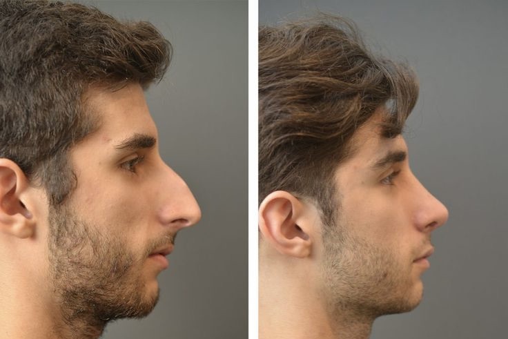 Male Rhinoplasty Revolution: Top Trends and Masculine Nose Designs for 2025  | MedPalTrip